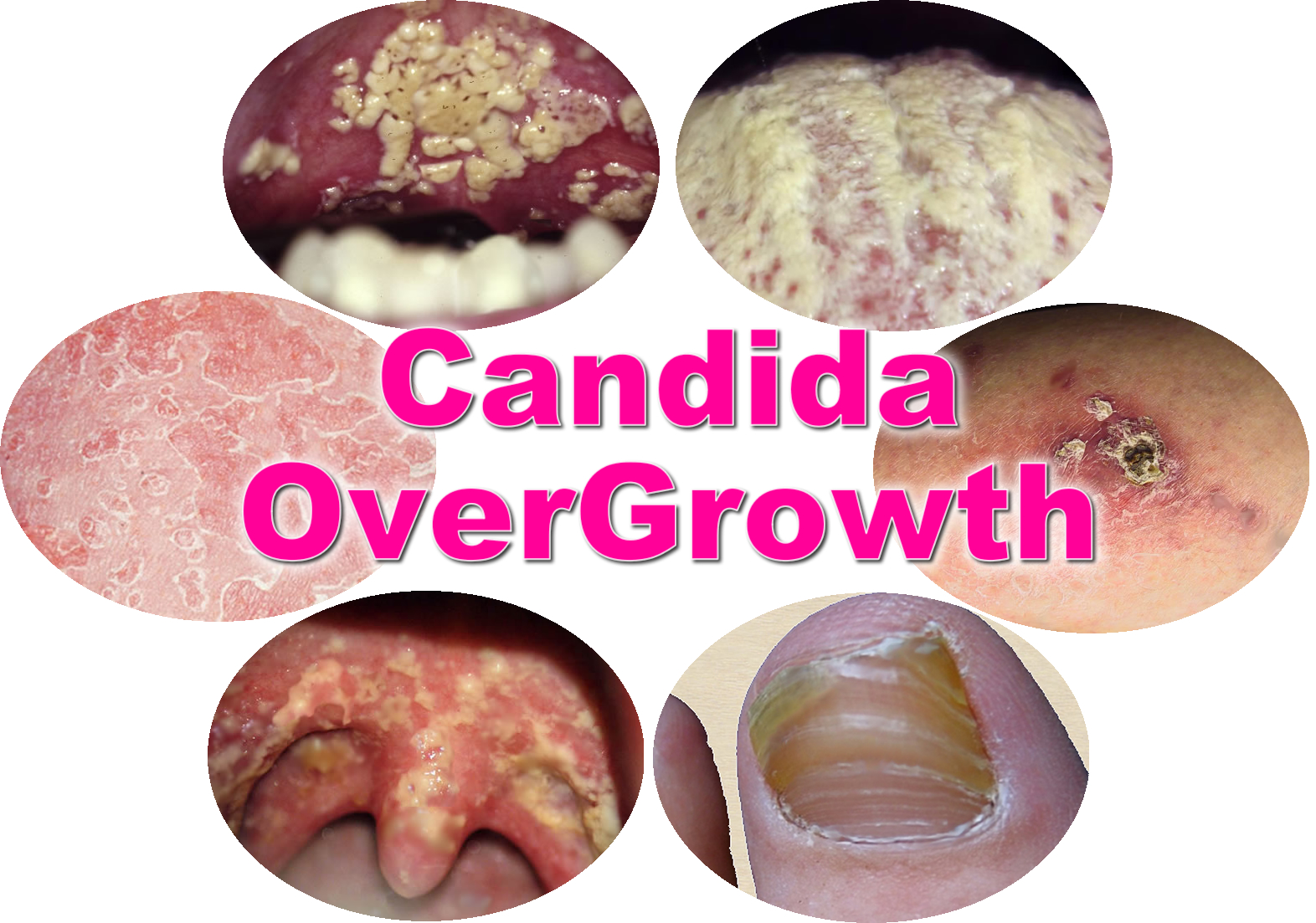 how to overcome candida naturally